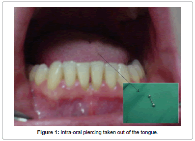 interdisciplinary-medicine-dental-science-Intra-oral-piercing-tongue