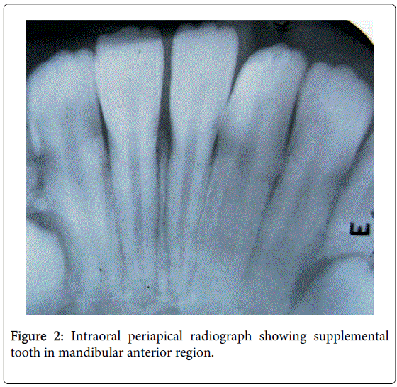 interdisciplinary-medicine-dental-science-Intraoral-periapical-radiograph