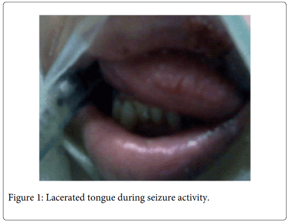 interdisciplinary-medicine-dental-science-Lacerated-tongue-seizure