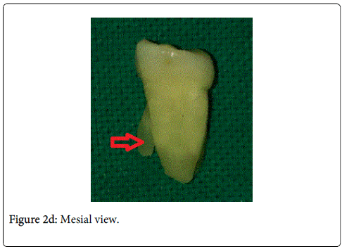 interdisciplinary-medicine-dental-science-Mesial-view