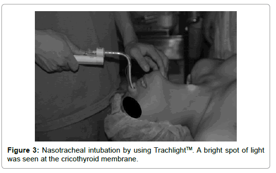 interdisciplinary-medicine-dental-science-Nasotracheal-intubation