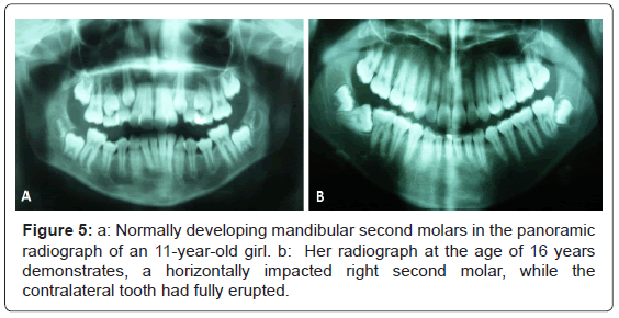 interdisciplinary-medicine-dental-science-Normally-developing-mandibular-second-molars