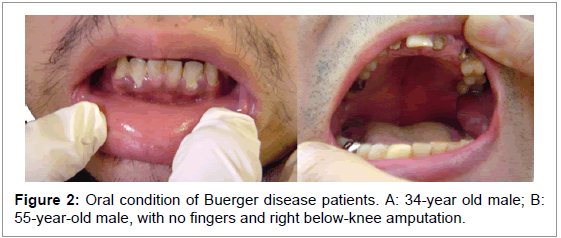 interdisciplinary-medicine-dental-science-Oral-condition-Buerger-disease-patients