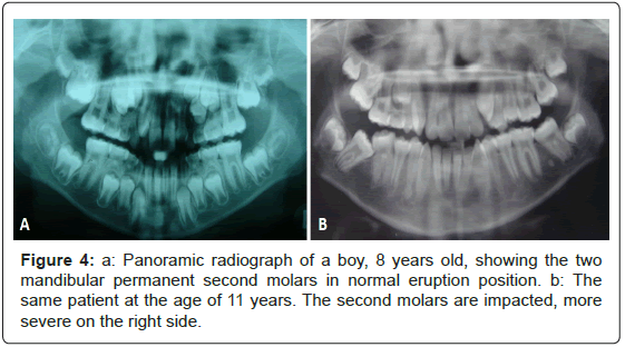 interdisciplinary-medicine-dental-science-Panoramic-radiograph-eruption-position
