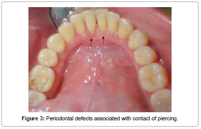 interdisciplinary-medicine-dental-science-Periodontal-defects-contact-piercing