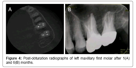 interdisciplinary-medicine-dental-science-Post-obturation-radiographs-left