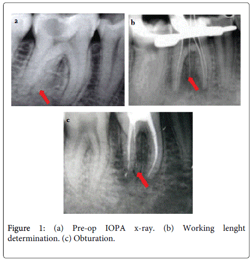interdisciplinary-medicine-dental-science-Pre-op-IOPA-x-ray