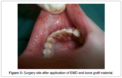 interdisciplinary-medicine-dental-science-Surgery-site-application-EMD