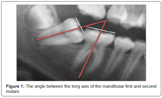 interdisciplinary-medicine-dental-science-The-angle-long-axis