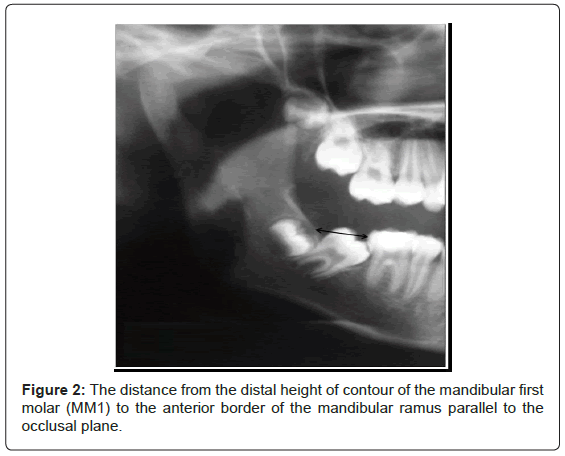 interdisciplinary-medicine-dental-science-The-distance-distal-height