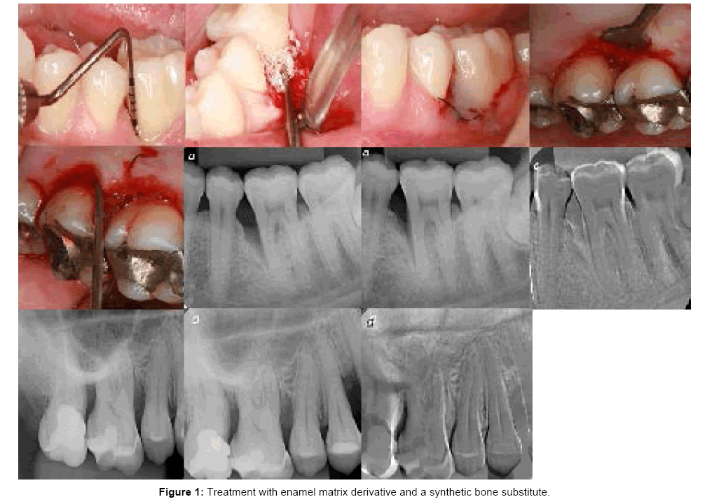 interdisciplinary-medicine-dental-science-Treatment-with-enamel-matrix