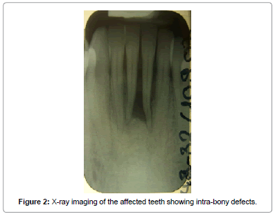 interdisciplinary-medicine-dental-science-X-ray-intra-bony-defects