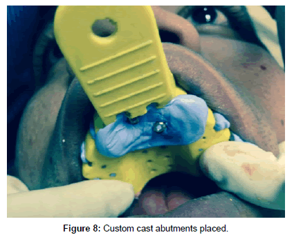 interdisciplinary-medicine-dental-science-abutments