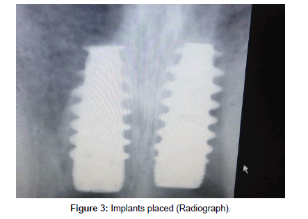 interdisciplinary-medicine-dental-science-implants-radiograph