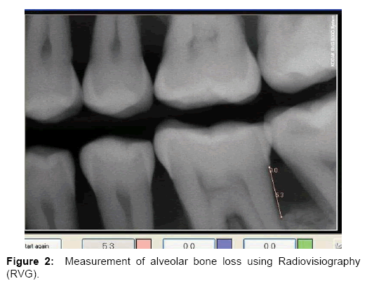 interdisciplinary-medicine-dental-science-loss-using-Radiovisiography