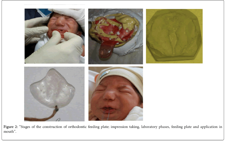 interdisciplinary-medicine-dental-science-orthodontic-feeding-plate