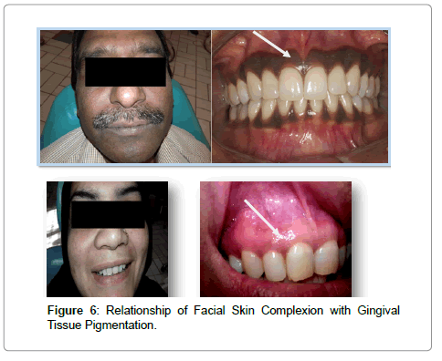 interdisciplinary-medicine-dental-science-pigmentation