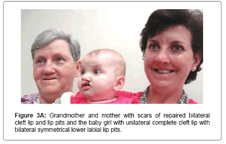 interdisciplinary-medicine-dental-science-repaired-bilateral-cleft-lip