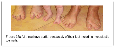 interdisciplinary-medicine-dental-science-three-partial-syndactyly