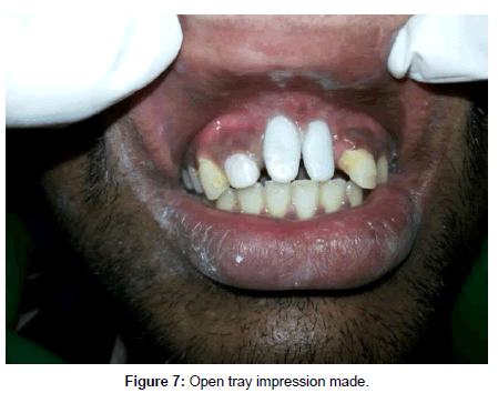interdisciplinary-medicine-dental-science-tray-impression
