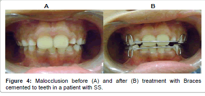 interdisciplinary-medicine-treatment-Braces-cemented