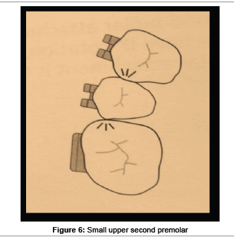 interdisciplinary-medicine-upper-second-premolar