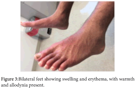 interdisciplinary-microinflammation-Bilateral-feet-showing