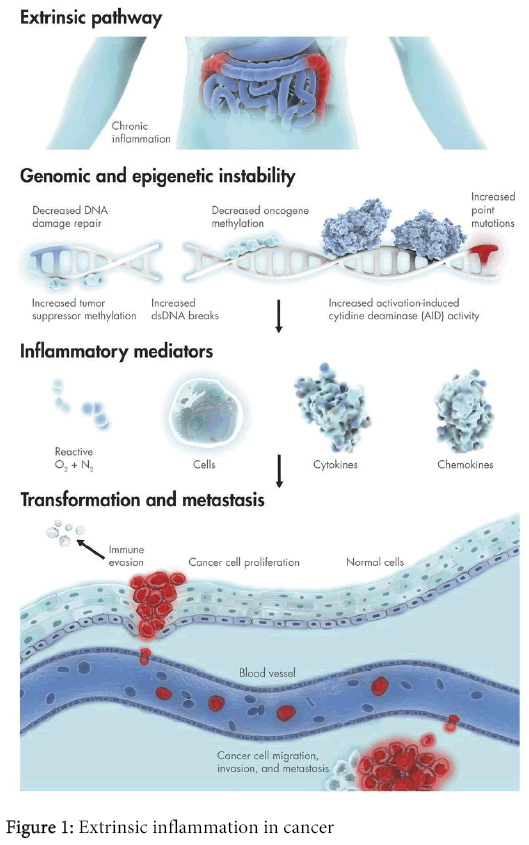 interdisciplinary-microinflammation-Extrinsic-inflammation-cancer