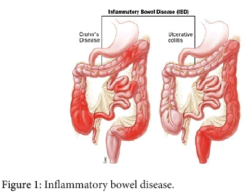 interdisciplinary-microinflammation-Inflammatory-bowel-disease