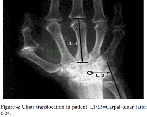 interdisciplinary-microinflammation-Ulnar-translocation