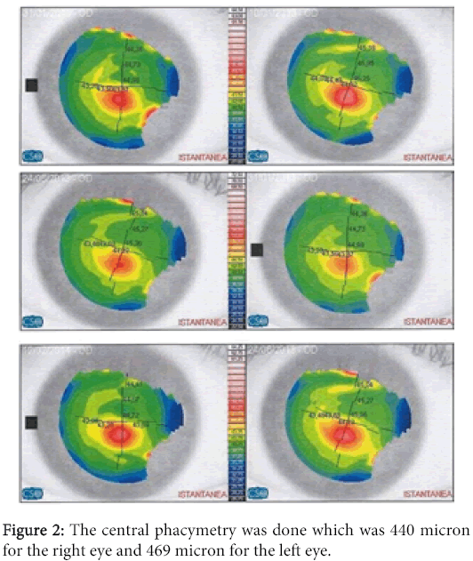 interdisciplinary-microinflammation-micron-left-eye
