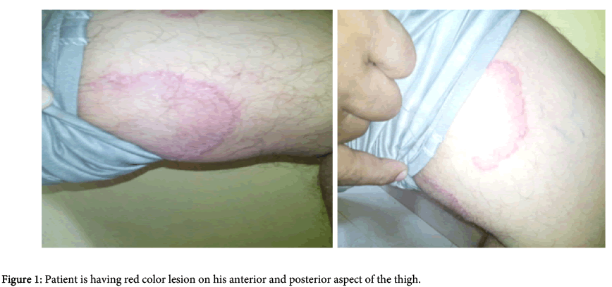 interdisciplinary-microinflammation-posterior-aspect-thigh