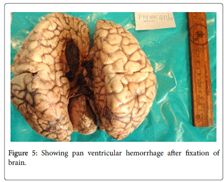 primary intraventricular hemorrhage in second trimester of pregnancy