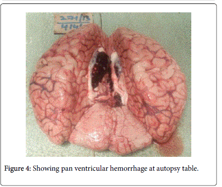 primary intraventricular hemorrhage in