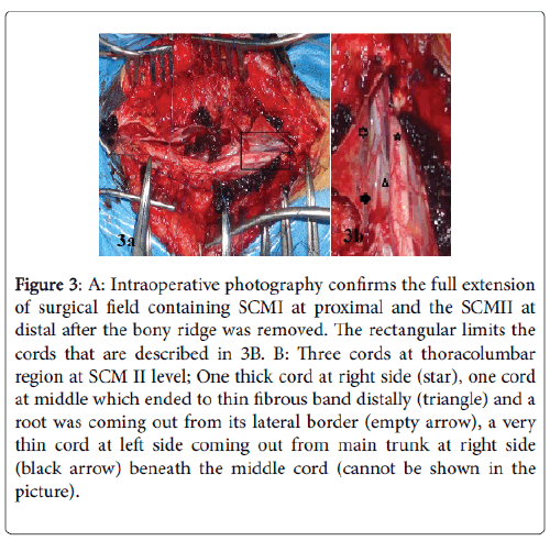 trifid cord very rare presentation of split cord malformation