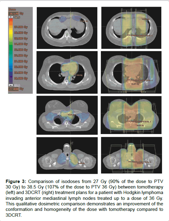 mediastinal lymphosarcoma