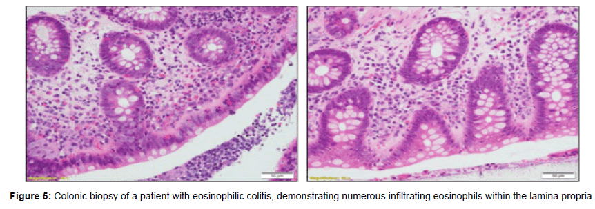 Eosinophilic GI Disorders (EGID) following