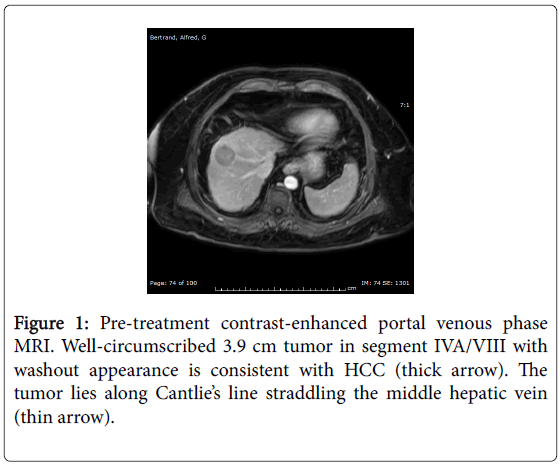 Watershed Hepatocellular Carcinoma and#8211; Utility of ...