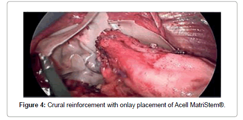medical-implants-surgery-crural-reinforcement