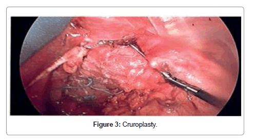 medical-implants-surgery-cruroplasty