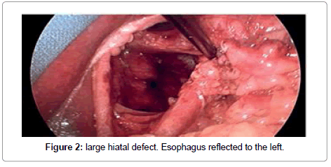 medical-implants-surgery-large-hiatal