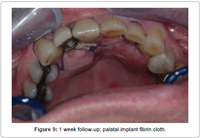 medical-implants-surgery-palatal-fibrin-cloth