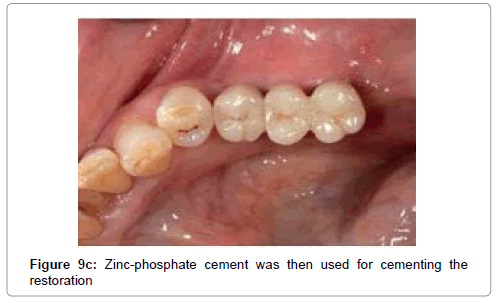 medical-implants-surgery-zinc-phosphate