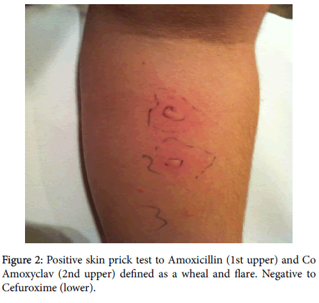 Cefixime allergic reaction go faster