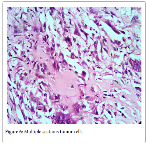 breast carcinoma and osseous metaplasia Eva maria sex