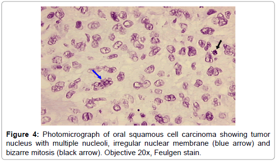 cancer cell nucleus an insight omics international