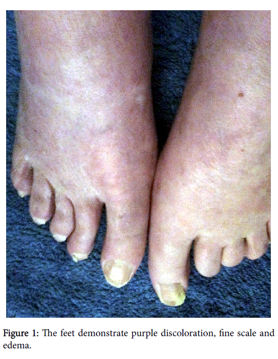 Multiple Sclerosis Purple Discoloration