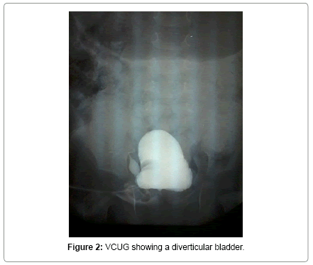 neonatal-and-pediatric-medicine-VCUG-showing-diverticular-bladder