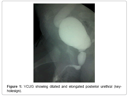 neonatal-and-pediatric-medicine-dilated-elongated-posterior-urethral