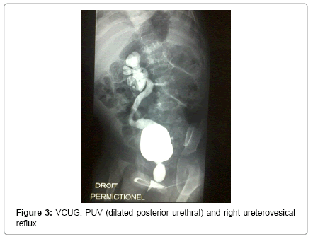 neonatal-and-pediatric-medicine-dilated-posterior-urethral